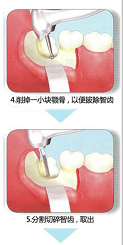 最新拔智齿技术，舒适、高效与安全的完美融合