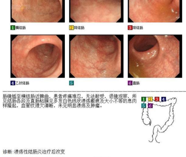 最新治疗技术在溃结领域的应用进展探究